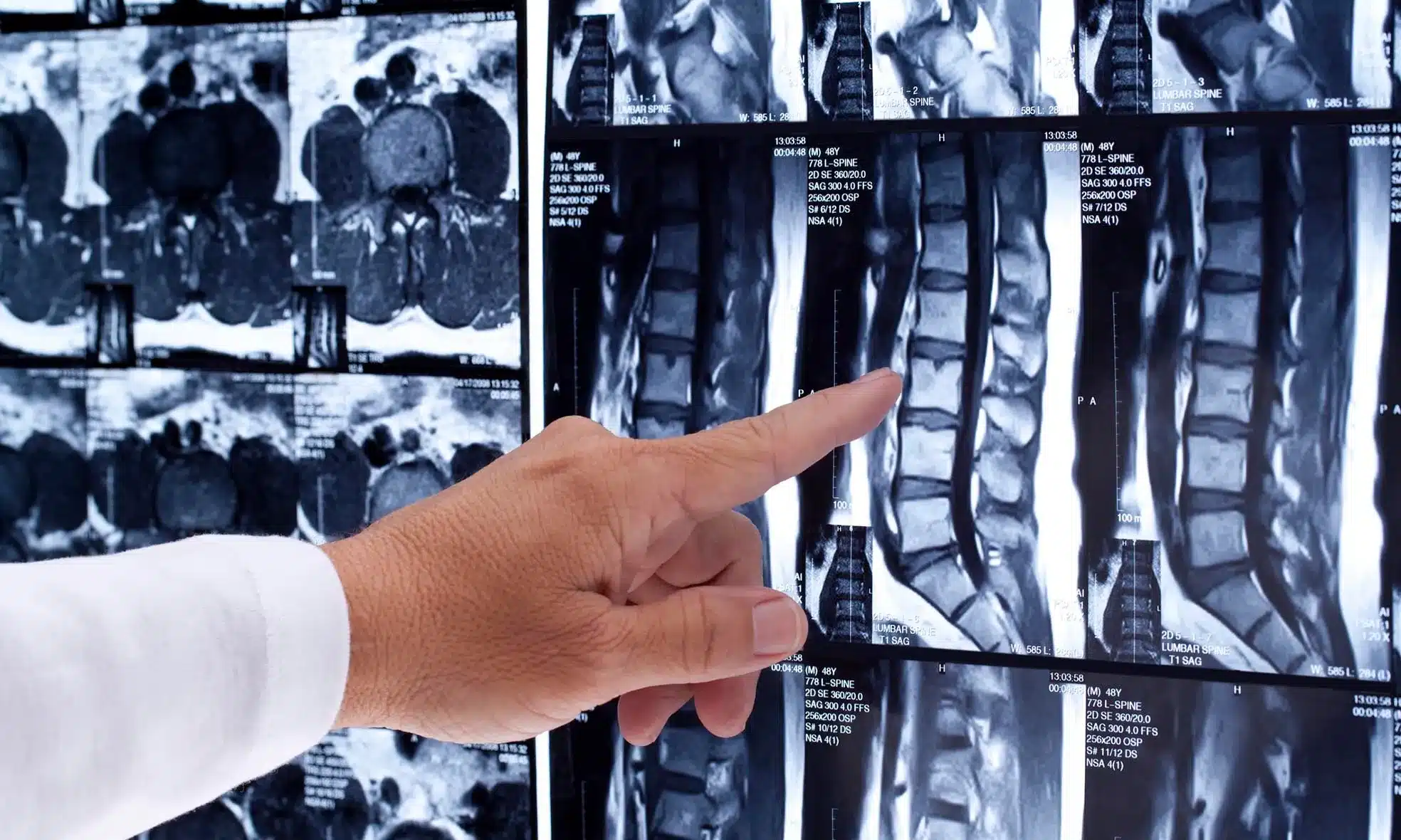 Spinal Cord Injuries Attorney